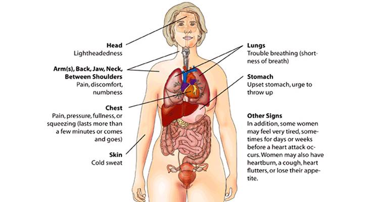 heart attack symptoms, women, lightheadedness, trouble breathing, short of breath, numbness, chest pain, discomfort, arms, back, jaw, neck, between shoulders, upset stomach, chest fullness, pressure, squeezing, cold sweat