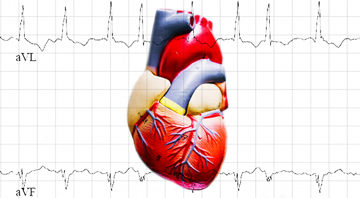 atrial fibrillation, afib, ecg, arrhythmia, heart rhythm, heartbeat, irregular, avf, avl, 