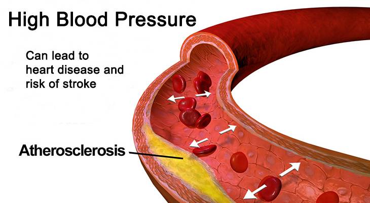 high blood pressure, heart disease, stroke, atherosclerosis, risk factors, prevention, causes