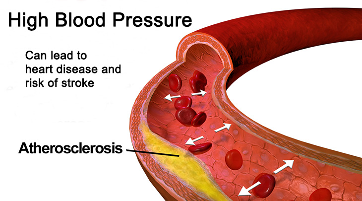 high blood pressure causes stroke