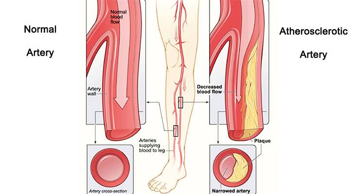 peripheral artery disease, pad, claudication, leg pain when walking, arterial disease, clogged arteries