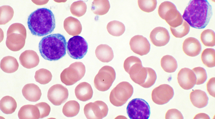 cll, blood cancer, leukemia, chronic lymphocytic leukemia, bone marrow, cancer cells,