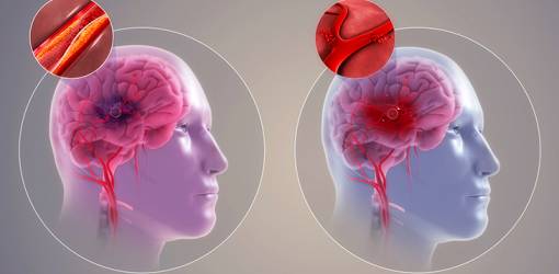 ischemic stroke, hemorrhagic stroke, impacts of stroke, blood clots, brain bleeds