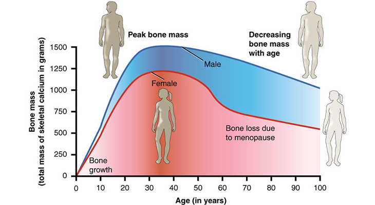 osteoporosis infographic, age and bone mass infographic, bone density, bone loss, stastics, prevlaence, fractures, broken bones