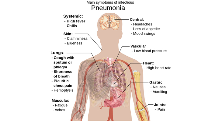 pneumonia symptoms, world pneumonia day, swelling of lungs, inflammation of lungs, infected lungs, leading cause of death, seniors, people over age 65, elderly, weakened immune system, cold or flu, pneumonia risk factors, prevention, smoking, smokers, pneumonia infographic