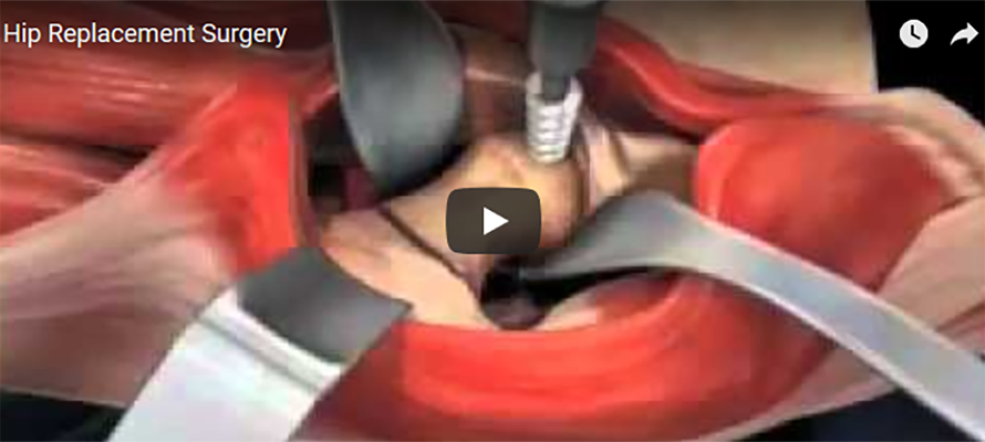 Hip Replacement Surgery Animation 50+ World